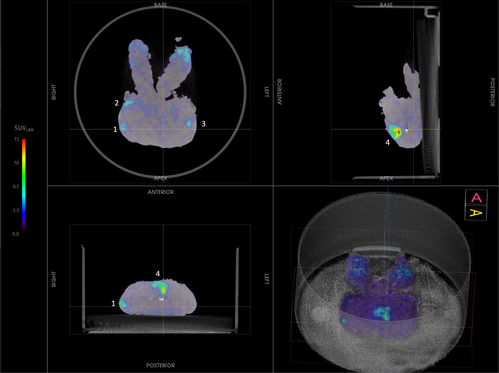 Imaging Case 18:
Prostate cancer - Adenocarcinoma