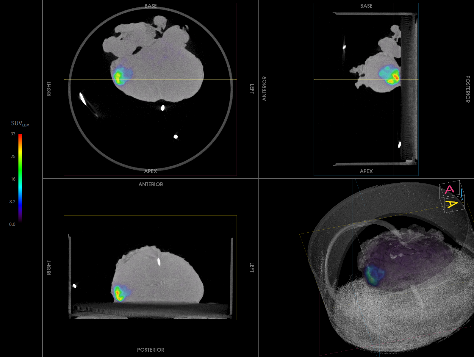 Imaging Case 19: 
Prostate cancer - Adenocarcinoma