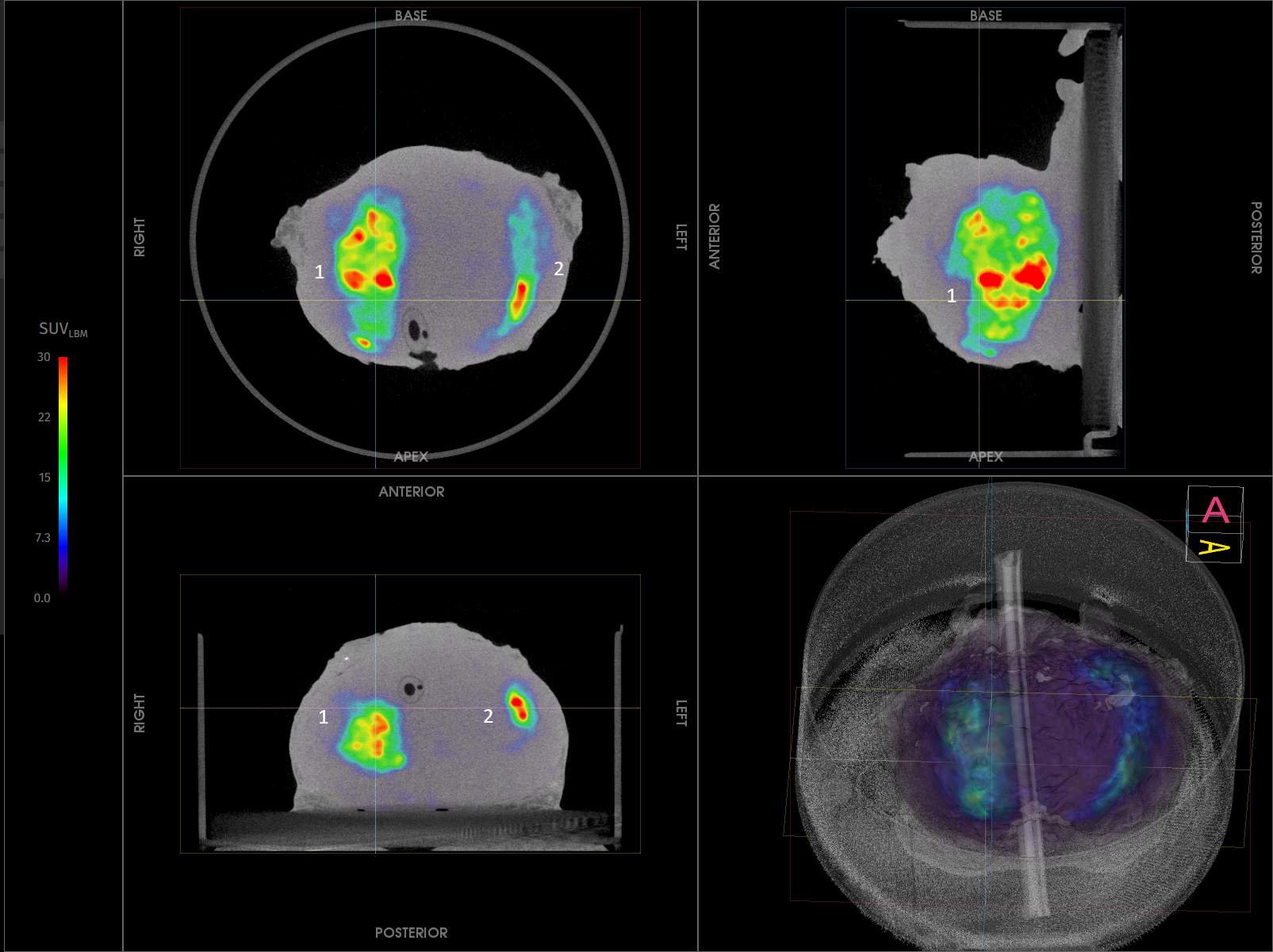 Imaging Case 20: Prostate cancer - Adenocarcinoma