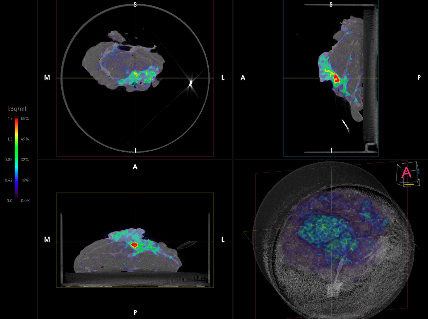 Imaging case 14:
Breast Cancer - Ductal Carcinoma In Situ