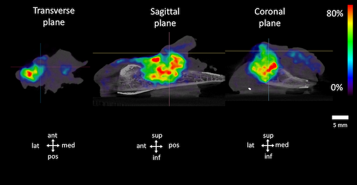 Imaging case 23:
Head &amp; Neck cancer - Squamous Cell carcinoma of the retromolar trigone